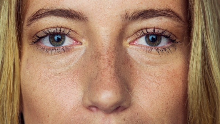 Exploring Nonsurgical Rhinoplasty: A Safe and Effective Alternative to Surgery